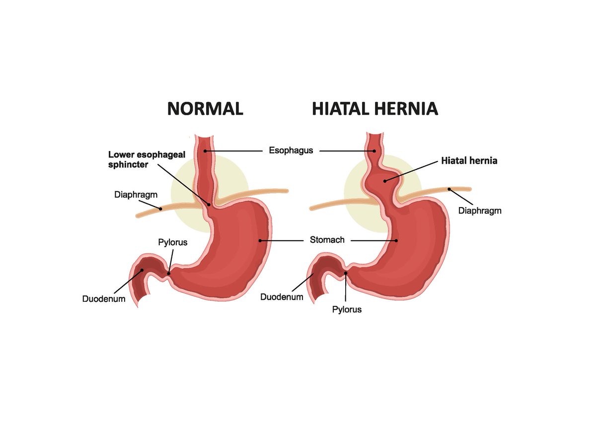 The hole in the diaphragm that the esophagus goes through is larger than it is supposed to be and allows the stomach to slide up into the chest. Depending on the size, this can cause GERD, or more serious complications. Click here to learn more: ow.ly/cE3O50JB2cm