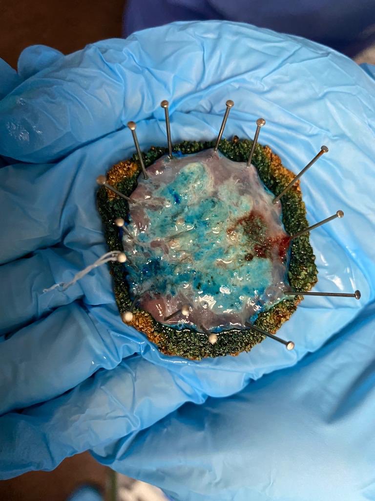 j_mtzsempere's tweet photo. Hoy un pasito más en la DSE en @EndoscopiaH  Primera disección en esófago. Carcinoma epidermoide T1
@carolmangas @j_mtzsempere y María y María José. Satisfacción y entusiasmo. https://t.co/u0vdTj6Frx