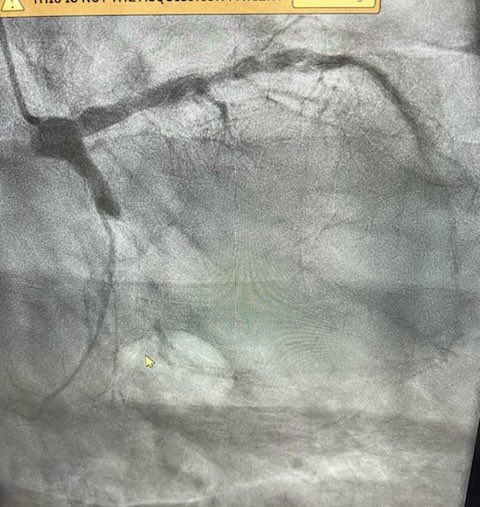 KeithNguyenSAIF's tweet photo. CTO intervention lcx @SAIFSanAntonio https://t.co/HtcXUcc0At