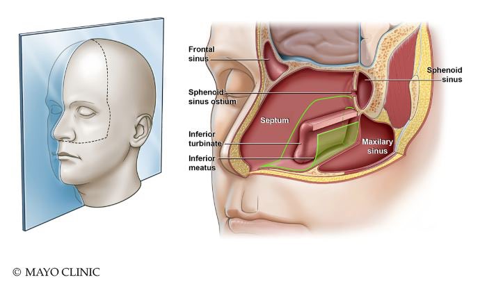 PerisCelda's tweet photo. Check out #TheLaryngoscope cover The Posterior Septal Nasal Floor Mucosal Flap for Cranial Base Reconstruction! from #Rhotonprogram @dr_pinheiro #andrewbowen et al @MayoClinicENT @MayoClinicNeuro illustration #stevengraepel https://t.co/0nBxgg7FR9 https://t.co/H7nwtQL2He