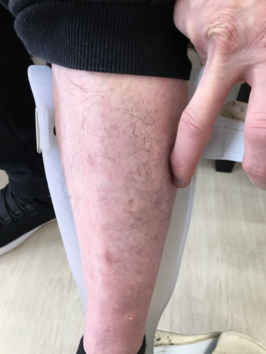locomoup's tweet photo. 下腿が痩せてしまう方、これもよくある事なのですが、気軽に調整できるスポンジキットみたいなのが欲しいです。 https://t.co/JvZk53DqHY