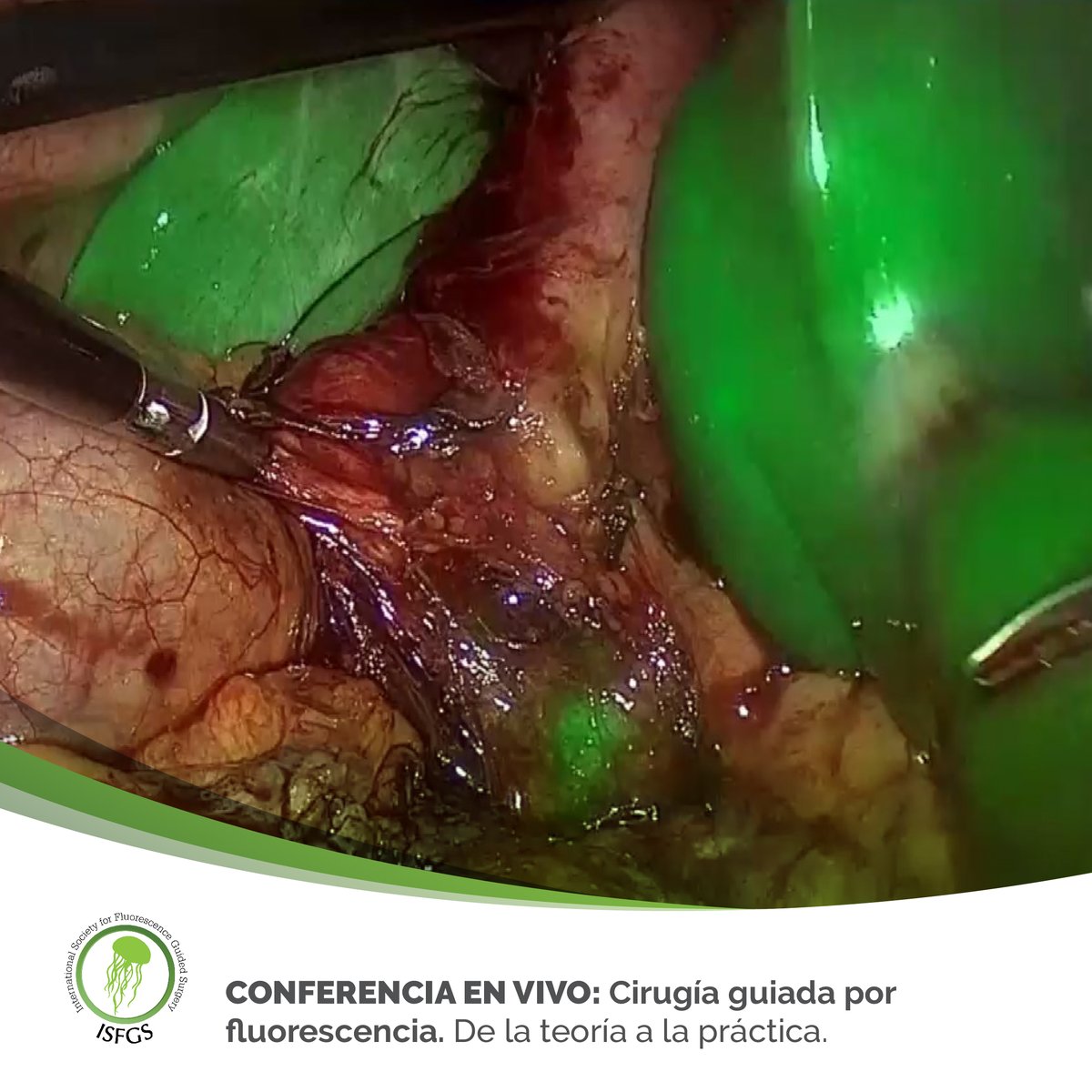 isfgs's tweet photo. 🇨🇷 Gracias Asociación Costarricense de Cirugía por el excelente recibimiento!🙌⁣
⁣
🎥Conferencia en vivo: #Cirugía guiada por #fluorescencia - de la teoría a la practica.⁣
⁣
🖥️ Revive el evento en nuestro canal de YouTube🔴 ISFGS
⁣
#ISFGS #ACCCR #ACC #Medtronic #glowgreen⁣ https://t.co/pyqNbdJ5Bo