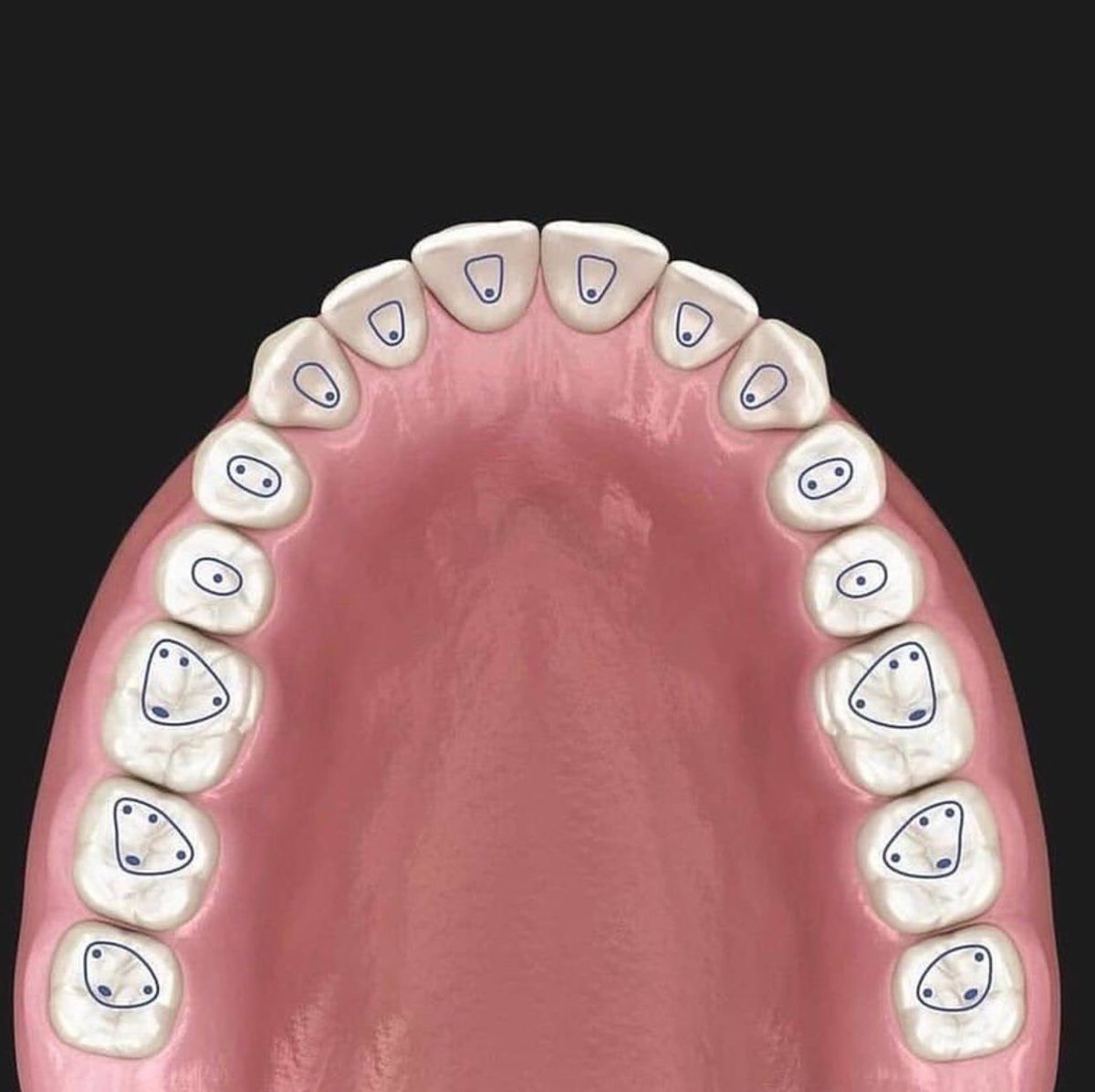 Dentalzone3's tweet photo. Access cavity: an opening in the crown of a diseased tooth (traumatised or carious) to enable the process of the biomechanical preparation and obturation each tooth have it’s unique access cavity form.
Here the outline forms for access cavities in every teeth (Endodontics) https://t.co/H5QMPTBUXq