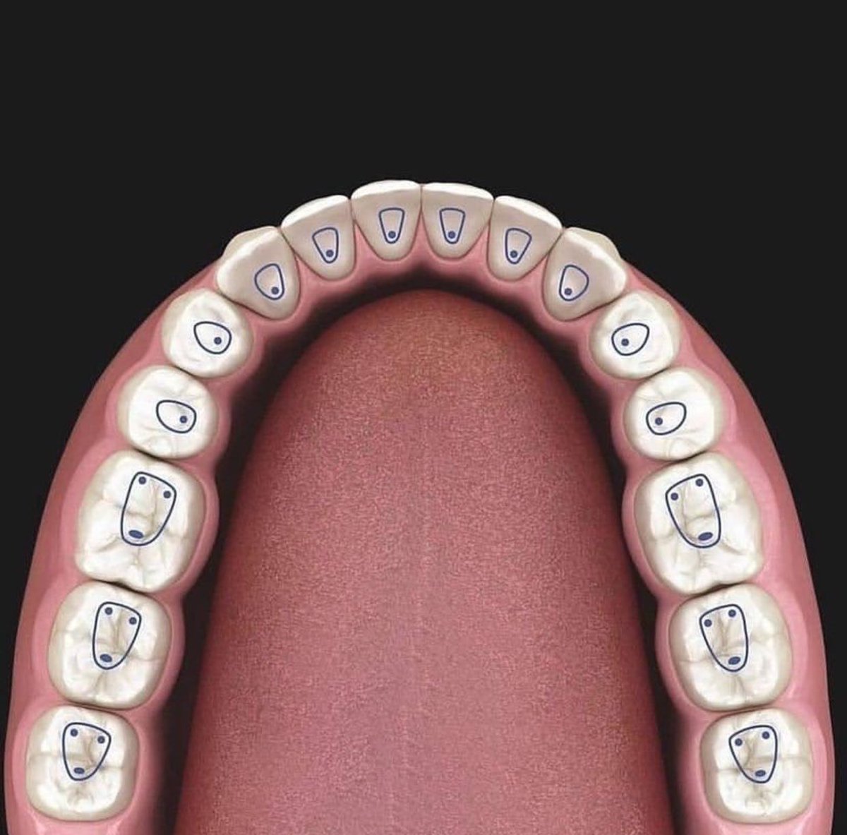 Dentalzone3's tweet photo. Access cavity: an opening in the crown of a diseased tooth (traumatised or carious) to enable the process of the biomechanical preparation and obturation each tooth have it’s unique access cavity form.
Here the outline forms for access cavities in every teeth (Endodontics) https://t.co/H5QMPTBUXq