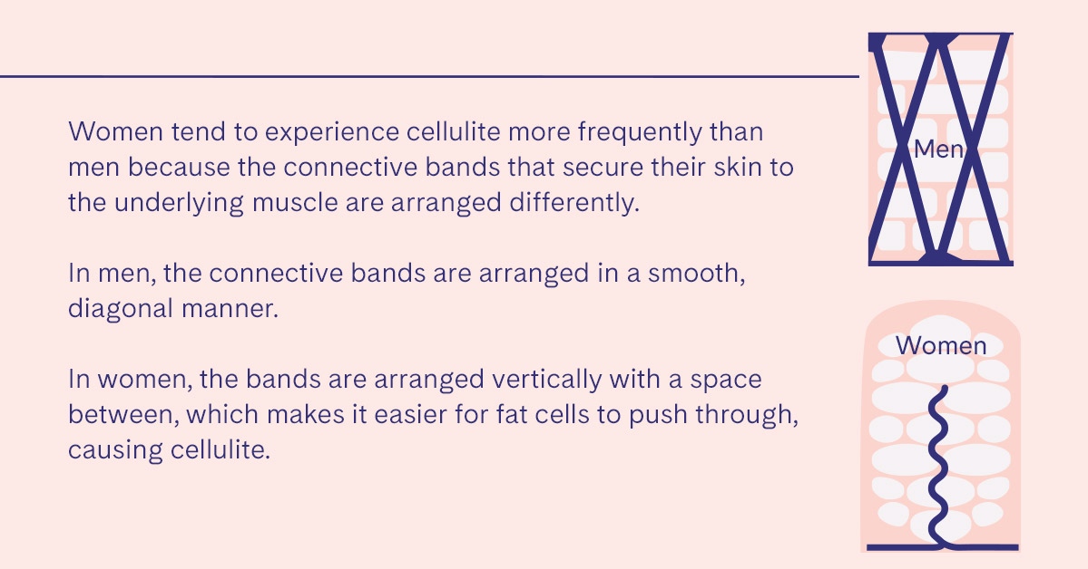 LovelySkin's tweet photo. Cellulite is normal, though often misunderstood. Swipe through to learn more! #LovelySkin #LovelySkinLovesYou #Cellulite #CelluliteisNormal https://t.co/4YW9phHN8V