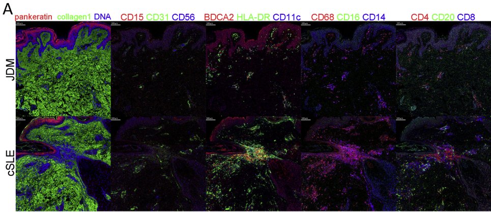Standard_BioT's tweet photo. Exciting new work from @UMich examines the role of cutaneous #inflammation in juvenile dermatomyositis compared to childhood-onset systemic lupus erythematosus using #highpleximaging.
#ImagingMassCytometry #cellprofiling #moremarkers #singlescan
https://t.co/FxWVal2MUX https://t.co/46E1RWZJdK