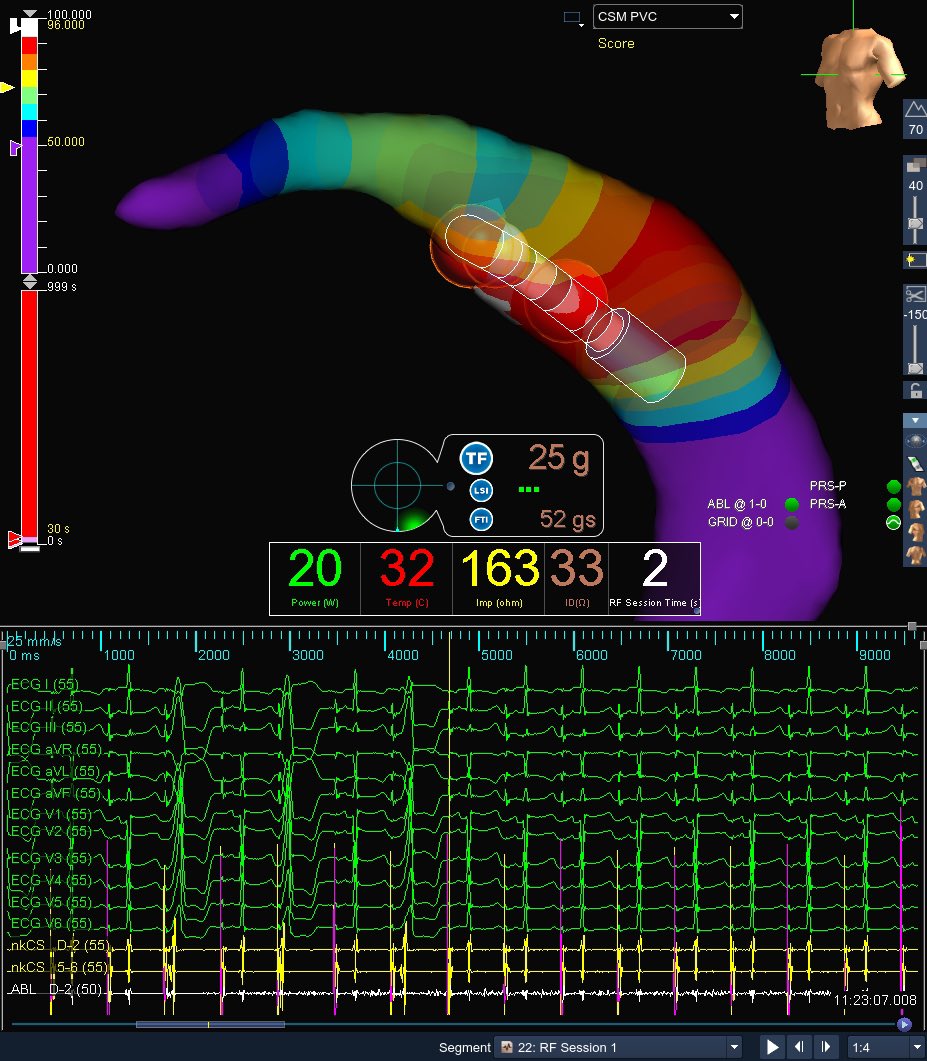 Lydia Trautmann (@lydtrautep) on Twitter photo No arterial or transseptal required for this inferiorly directed, right axis PVC. An MDI of .59 combined with #ECG morphology led us to an anterior GCV origin. 96% paced correlation, LAT -44 msec, first #RF application resulted in cessation within 2 seconds. <a href="/EPS_PDX/">D Randy Jones</a> #PDXMapping No arterial or transseptal required for this inferiorly directed, right axis PVC. An MDI of .59 combined with #ECG morphology led us to an anterior GCV origin. 96% paced correlation, LAT -44 msec, first #RF application resulted in cessation within 2 seconds. <a href="/EPS_PDX/">D Randy Jones</a> #PDXMapping