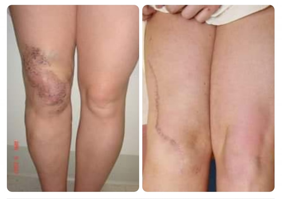 Klippel-Trenaunay syndrome ― also called KTS ― is a rare disorder found at birth involving problems in the development of certain blood vessels, soft tissues, bones and sometimes the lymphatic system. 
(via Mayo Clinic)