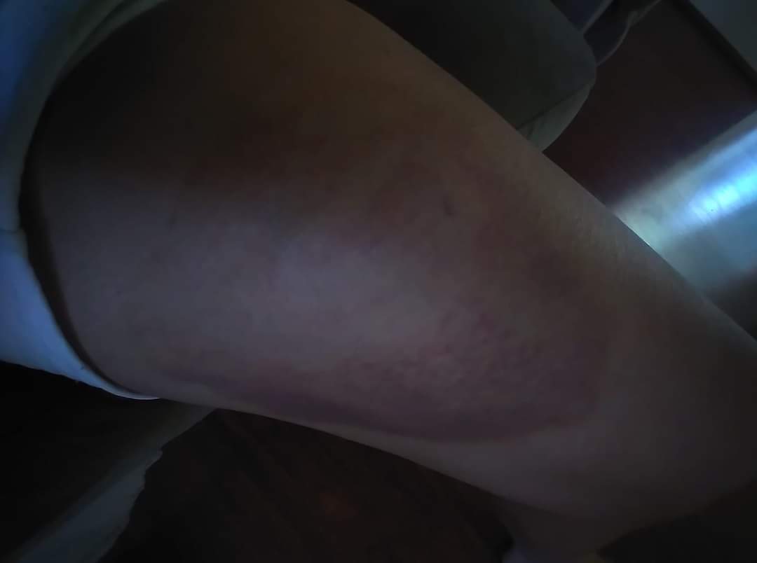 jagclamp's tweet photo. @thatmasonrygirl @masonry_hhs This is from 2020. This mason took a line block to her knee. Lucky it didn't shatter it.  A completely unnecessary and avoidable accident. https://t.co/uWuERPV7db