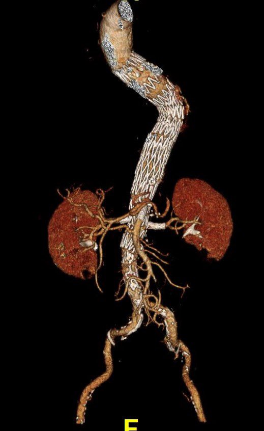 PMEG for a ruptured Crawford extent I TAAA. Total percutaneous access. Uncertain of the Celiac artery patency on a poorly timed preop CTA- occluded. Excellent exclusion of the aneurysm. #PMEG, #MHI vascular