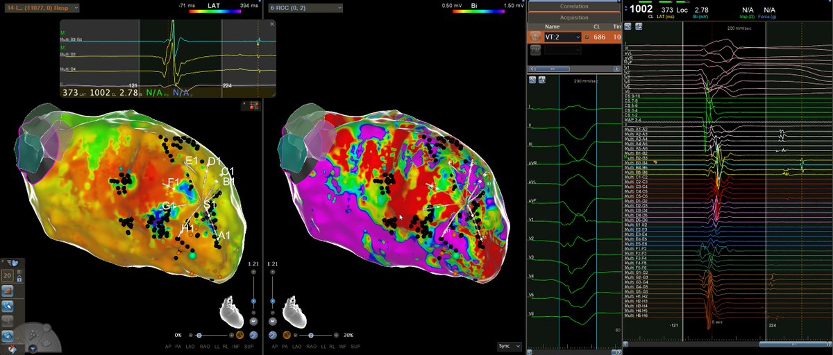 OctaRay has been primarily marketed as an atrial mapping catheter, but I think it may be undersold in it's role in the ventricle. 2Fr splines, much softer than PentaRay with noticeably less ectopy. Rapid mapping and beautiful signals using indwelling reference electrode.