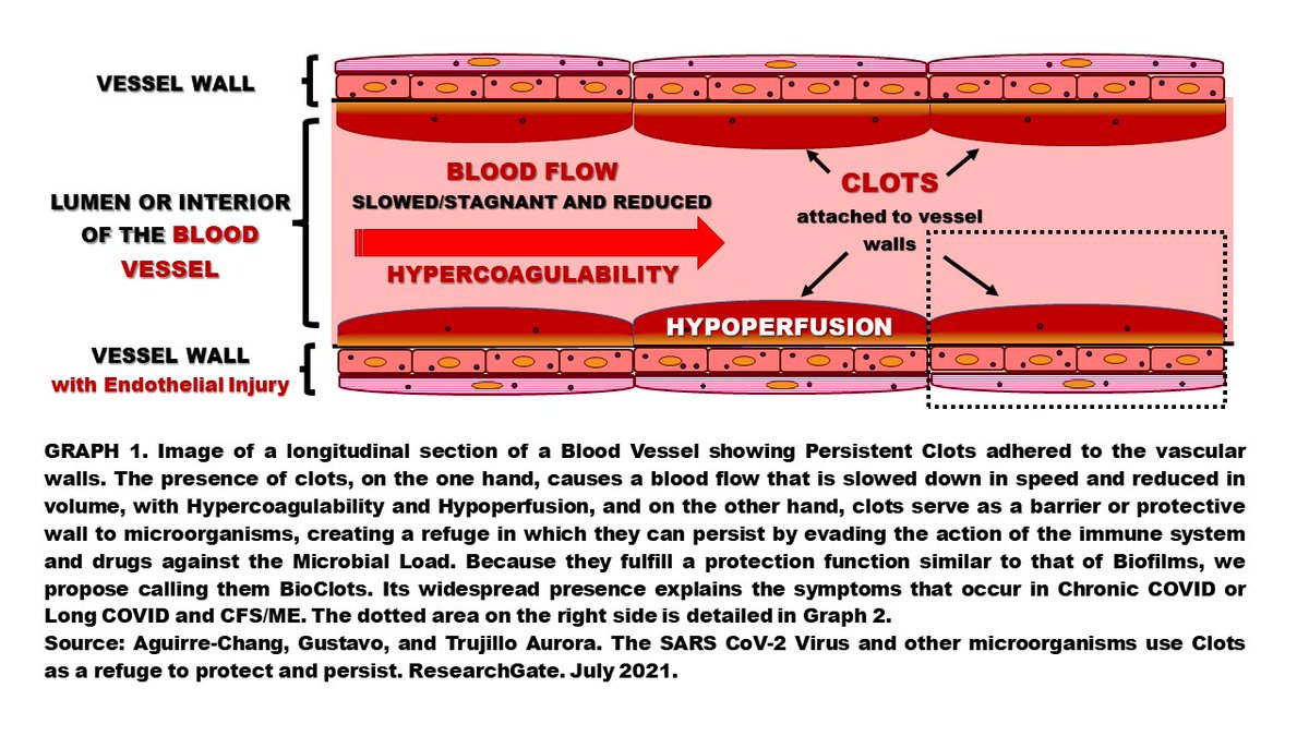 Aguirre1Gustavo's tweet image. It is one of the cases in which the lungs have a large number of #BioClots
LMWH such as Enoxaparin breaks part of the clots and there is improvement
but high persistent Viral Load generates persistent clots again.
Mechanical removal of the numerous pulmonary BioClots is necessary