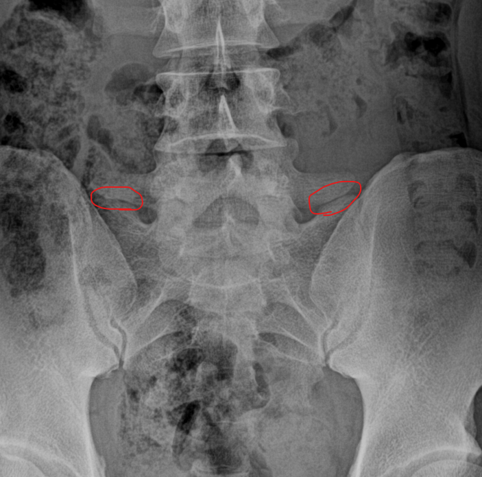 docskalski's tweet photo. Young person with chronic recurrent pain at the lumbosacral junction. Lumbar radiographs are suspicious for non-transitional Bertolotti syndrome. I suggested an angulated lumbosacral spot view to see if this is projectional before MRI. https://t.co/JN5V2eSaXG