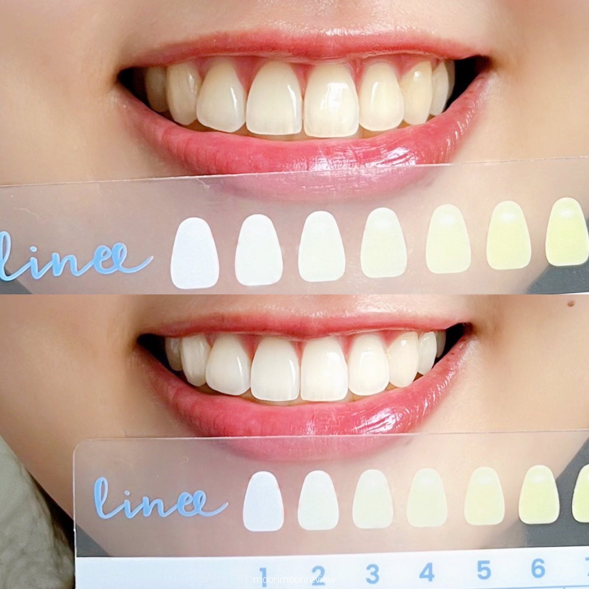 ฟันขาวขึ้นจริงๆนะเนี่ย เครื่องฟอกฟันขาว linee ใช้ไม่อยากเลยอะ ชิลมาก บีบน้ำยาใส่เทรย์ตามคู่มือ ประกอบกับเครื่องฉายแสง จัดการเลยจ่ะ ทิ้งไว้ 15-20 นาทีเท่านั้น หลังใช้บ้วนปากให้สะอาด จริงๆรู้สึกฟันเริ่มขาวขึ้นตั้งแต่ครั้งแรกเลย ทำเองที่บ้านง่ายๆ นี่ชอบทำก่อนนอนสบายสุด #ของดีบอกต่อ