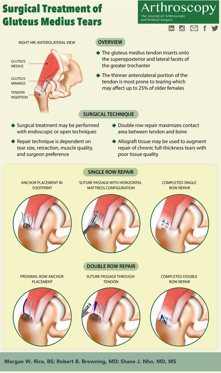 ArthroscopyJ's tweet photo. The July '22 Infographic! Surgical Treatment of Gluteus Medius Tears https://t.co/NHvkOiYOGJ https://t.co/FdVl81vi0I