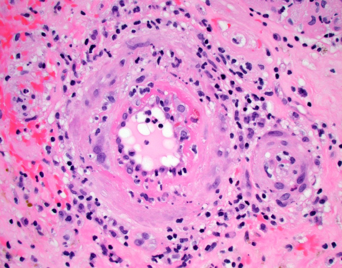 JZRenalPath's tweet photo. Failed allograft nephrectomy with illustrative examples of severe vascular rejection (transmural inflammation and necrosis). #renalpath #pathwtitter. https://t.co/l8w3d5pa8T