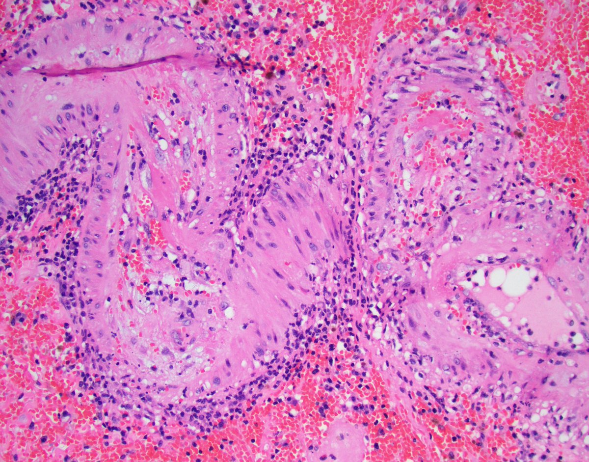 JZRenalPath's tweet photo. Failed allograft nephrectomy with illustrative examples of severe vascular rejection (transmural inflammation and necrosis). #renalpath #pathwtitter. https://t.co/l8w3d5pa8T