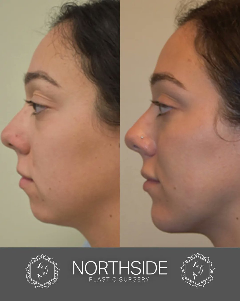 drmike_facemd's tweet photo. This is a 30-year-old female who desired greater balance to her side profile. The underwent a chin implant placement which restored desired balance and harmony to her face. 
#chinimplants #chinimplantsurgery #chin https://t.co/mJGUsOelq0