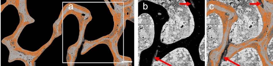 ASBMR's tweet photo. Authors in a new #JBMR study analyzed transiliac bone biopsy samples from eleven individuals before and after 48 weeks subcutaneous burosumab treatment (1.0 mg/kg administered every 4 weeks) 

#ASBMR @SonjaJaegerx @WileyBiomedical 

https://t.co/DZCU11jxF0 https://t.co/dP9zOiIm60