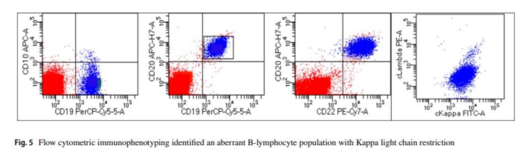 KirillLyapichev's tweet photo. We are happy to finally share our experience in @HeadNeckPathol in our recent manuscript, which could be immensely helpful for healthcare professionals. We proposed the University of Texas Medical Branch @UTMB_Pathology diagnostic approach for Primary Bone Lymphoma! #hemepath https://t.co/4sxR7yzZVc