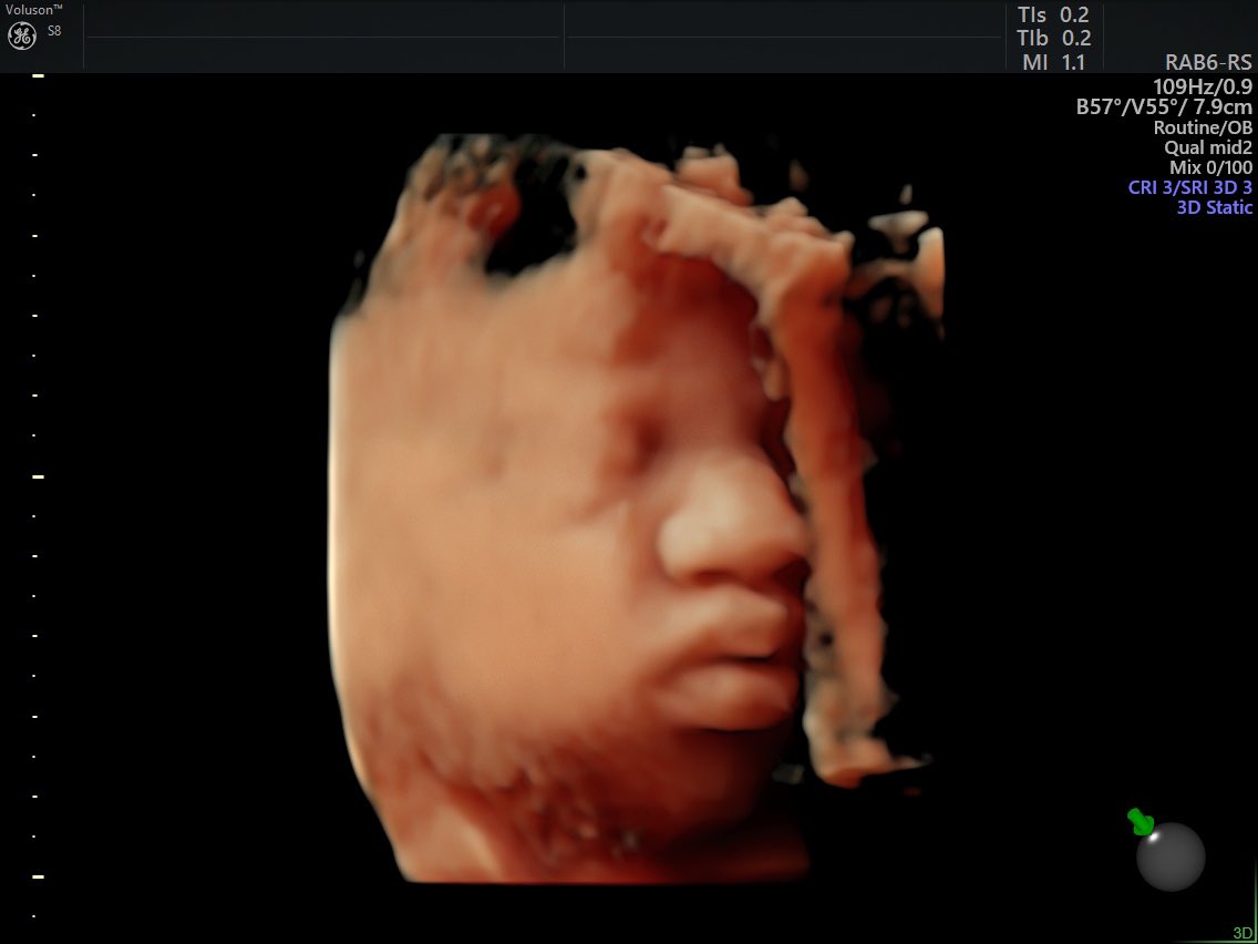CryptoKinshe's tweet photo. Got to see my baby boy this morning 🏦❤️💪🏾 4lbs 7oz #8moreweeks https://t.co/8rrk0L9xXk