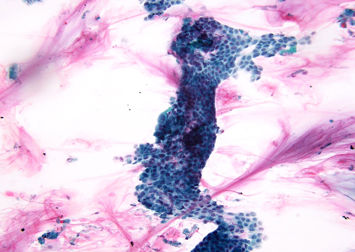 sza_jhcyto's tweet photo. "Be Careful" when evaluating transrectal FNAs for recurrent Colon CA. One could aspirate abundant luminal mucin with benign epithelium, which could be overinterpreted. In this case, however, the ACA fragment was clearly identifiable in patient with a history of "Colloid CA". https://t.co/nnYlrpHBWA