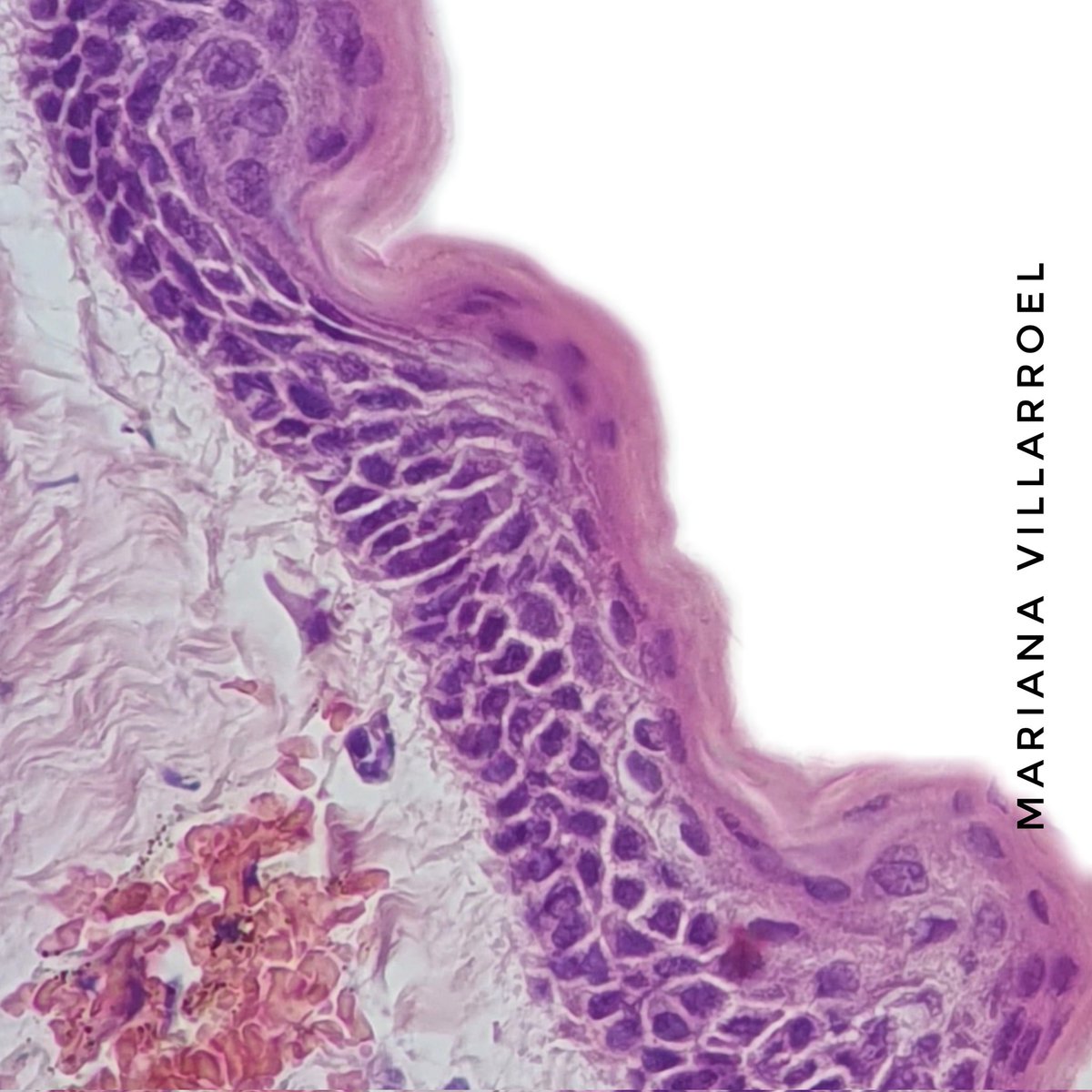 Odontogenic keratocyst #oralpath 🤍