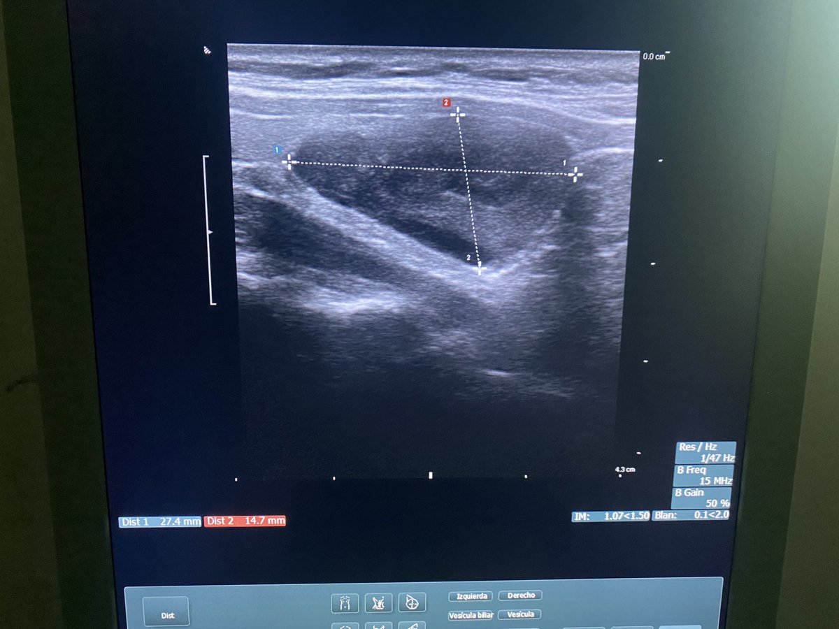Intrathyroid parathyroid adenoma. PTH 600, calcium 13.0. After right Hemithyroidectomy PTH 49. #parathyroidawarenessmonth