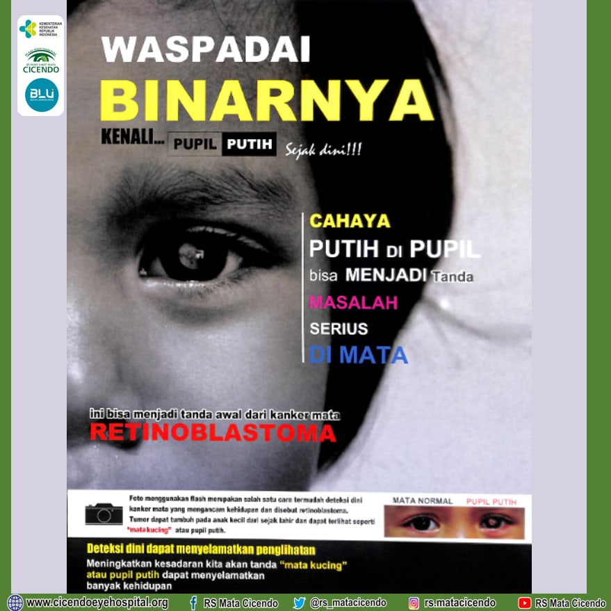 rs_matacicendo's tweet image. Cahaya atau Binar Putih pada Pupil bisa menjadi tanda serius pada mata buah hati kita. Segera periksakan untuk masa depannya! #SalamSehatMata #edukasi #pkrs #retinoblastoma #pupilputih #rsmatacicendo #blubanggamelayanibangsa
