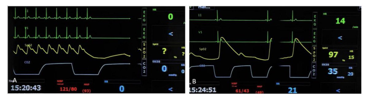 EurSpineJournal's tweet photo. Transcranial electric stimulation motor evoked potentials for cervical spine intraoperative monitoring complications.
https://t.co/4COL4Rk0o3 https://t.co/CHlKuVt8Wg