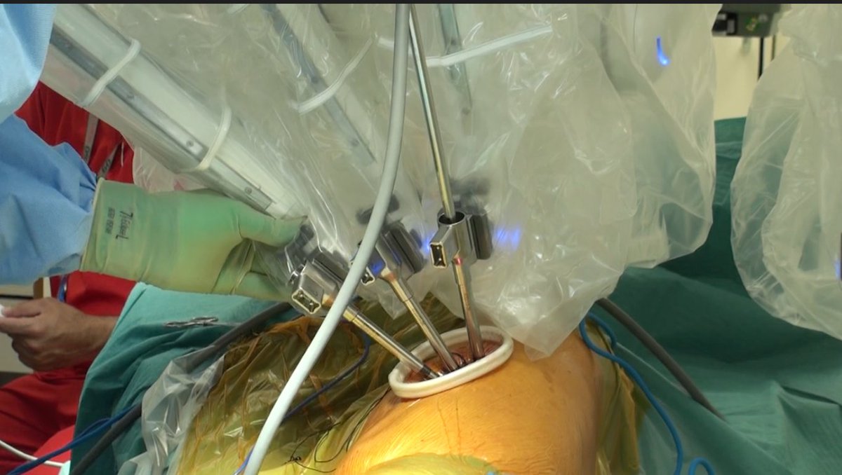 My registrar's first uniportal robotic left lower lobectomy youtu.be/Ojl3Ar7Y-L0