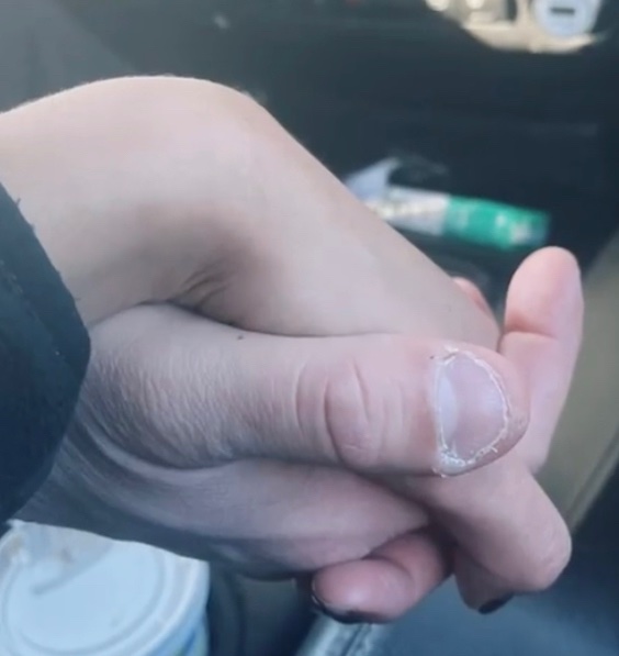Why every man’s thumb look like this