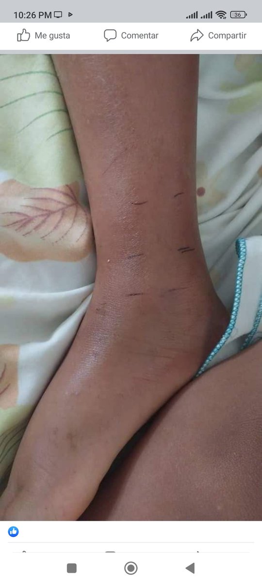 MariaGArocha's tweet photo. #SueroAntiofidico La niña Elizabeth Suárez, de 5 años fué mordida por una mapanare en su casa, en San Rafael de Onoto y se encuentra en el hospital #JMCasalRamos remodelado, pero sin insumos!  mucho menos el antídoto que requiere la pequeña y debería ser prioridad en el llano. https://t.co/IhLLuQmRGu