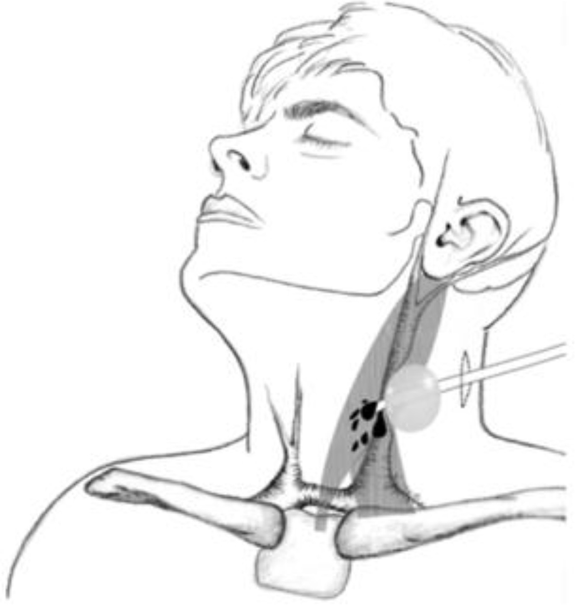The nonurologic uses of Foley catheters head and neck edition. A