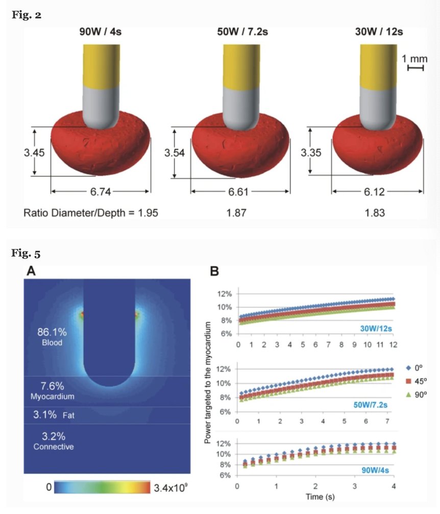 JICE_EP's tweet image. 🚨In the Latest @JICE_EP #Freeread
Using an in silico model, J Perez, Hiroshi Nakagawa, and @Davilandre elegantly compare lesion size &amp;amp; temperature dynamics between vHPvSD, HPSD, &amp;amp; MPSD using equivalent total energy delivery (360 J)
📖Read here it: rdcu.be/cRhtS
#EPeeps