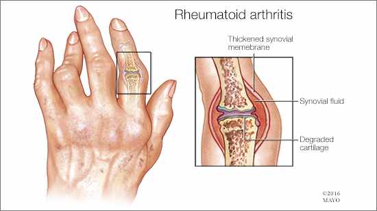 MayoClinic's tweet photo. 6 tips to manage rheumatoid arthritis symptoms: https://t.co/DbyAlYsiwp https://t.co/wEFrXXWt4v