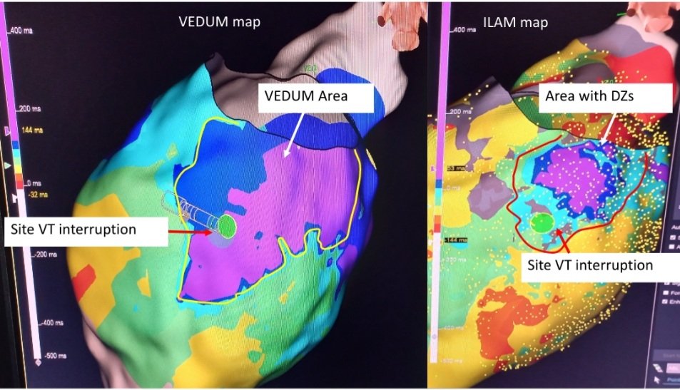 LV substrate during SR: case presenting area with DZs (ILAM map) inside the VEDUM area. Combination of methods could be the best. <a href="/FilippoCauti/">Filippo Maria Cauti</a> <a href="/stefbianchi/">Stefano Bianchi</a> <a href="/DrRoderickTung/">Roderick Tung</a> <a href="/Dr_Santangeli/">Pasquale Santangeli</a> <a href="/sozi81/">Antonio Frontera</a> #EPeeps #VEDUM