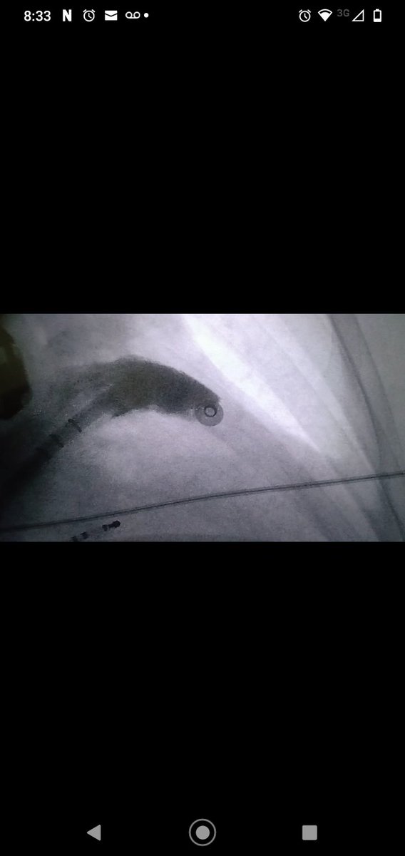 Speranzaric's tweet photo. Cierre orejuela izq  con Watchman Flex, realizado en @hospitalposadas, junto a @pablospaletra, Dr. Felipe Olivieri,y todo el equipo de Electrofisiologia. M Gracias al soporte de CCV y anestesia. @GusCostaEP @ALFIEEP1 @KamilaOlivera13 @DanielDeluso @diegoclinico @jorgeferreyrar https://t.co/w338oqWH35