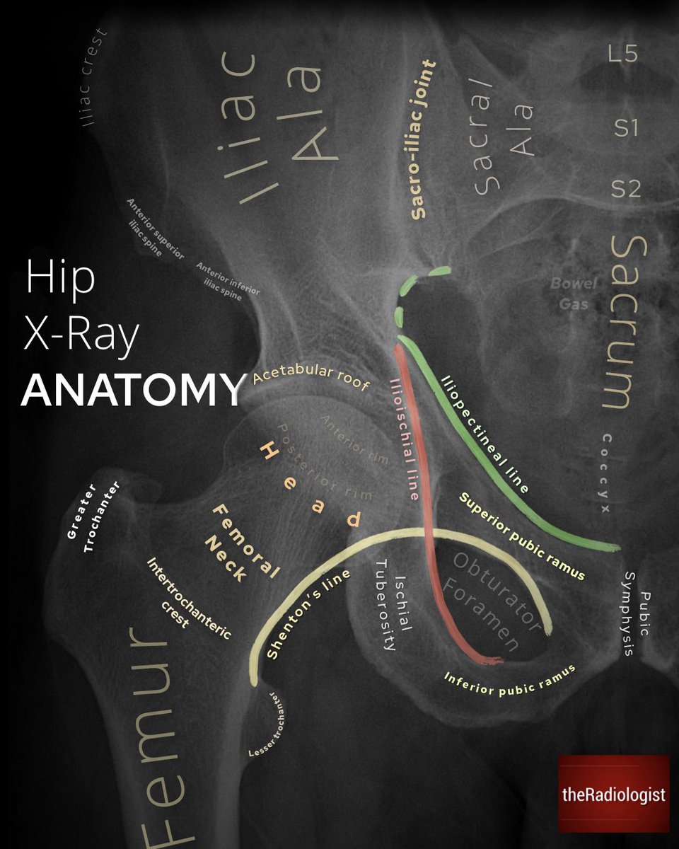 radiologistpage's tweet photo. HIP X-RAY ANATOMY

▫️ILIOPECTINEAL LINE: disruption can mean an ANTERIOR column acetabular fracture
▫️ILIOISCHIAL LINE: disruption can mean a POSTERIOR column fracture
▫️SHENTON’S LINE: disruption can mean a NOF fracture https://t.co/maVqAZZQiF