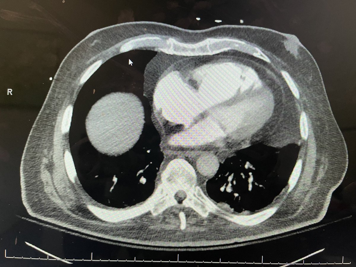 Done recently at @WFCardiology @AtriumHealthWFB @wakeforestmed. 81 yo male, one episode of syncope and dyspnea for 18 hours. PMH - HTN, HLD, BCC ear, DM. Exam - HR 120, MAP 70, SpO2 90% on 6 L NC. Responsive, alert, normal CV/lung exam. ECG and CT as below. 1/