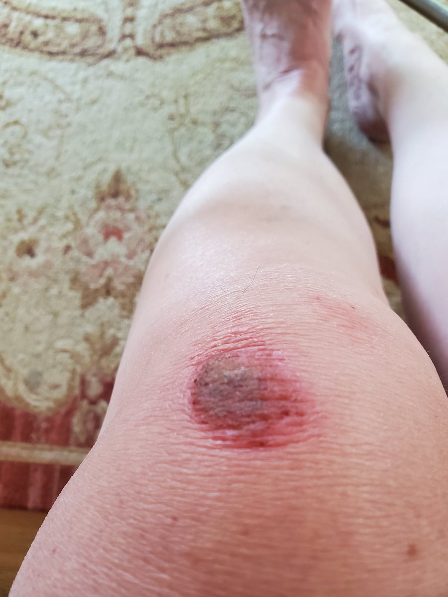 redjane's tweet photo. When I said I wanted to feel like a kid again, this is not exactly what I had in mind.
Tracking the healing process. #SkinnedKnee https://t.co/6gokGwhzo5
