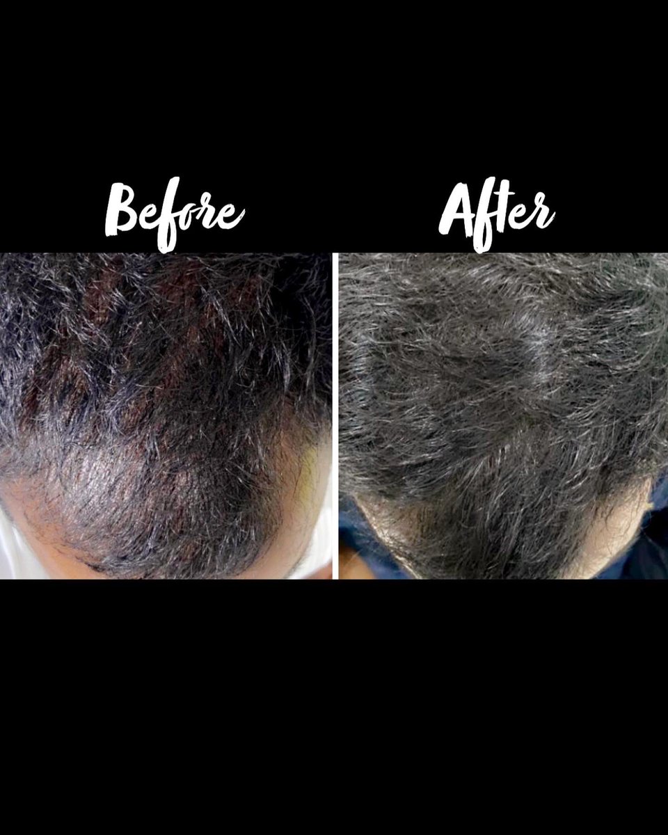 DrHamed's tweet photo. Back to hair @DrHamed naijerpolyclinic hyderabad https://t.co/nHqRMMa8el