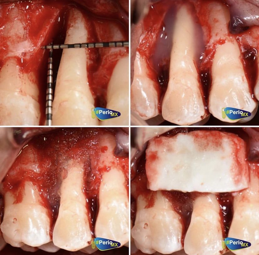 PerioMX's tweet photo. Les dejamos un caso clínico donde la motivación y el uso correcto de la biotecnología de materiales pudo hacer la diferencia y dar una posibilidad que muchos no creían.
✔️Amelogeninas
✔️Hueso alogenico #Grafton
✔️Matriz dérmica acelular #Alloderm
EXCELENTE FIN DE SEMANA https://t.co/FsbuigDcCm