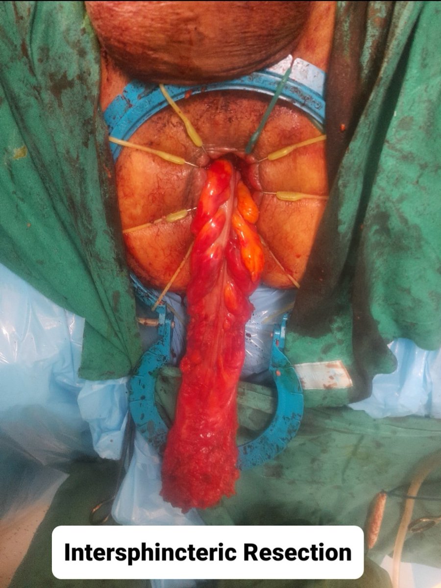 drsanjeev2003's tweet photo. #VeryLow #rectalcancer #roboticsurgery #sphincter #preservation 
A month of challenging cases.Very low rectal cancer, high BMI, male pelvis, post RT
Sphincter preservation,  intersphincteric resection, ultralow resecton
Use of  #davinci #Robotic surgery 
#GIcancer #PushingLimits https://t.co/CXAdryndXh