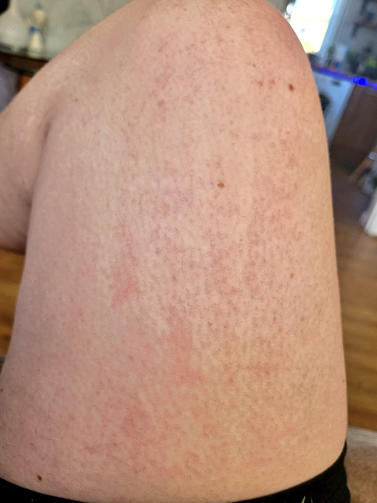 gemilouisexo's tweet photo. So I'm supposed to "avoid" the sun whilst on my new medication....now I know why. Im having a #phototoxic reaction 😢 #phototoxcity #photosensitive #photosensitivity #Sunburn #allergicreaction https://t.co/yIvvQckJPL