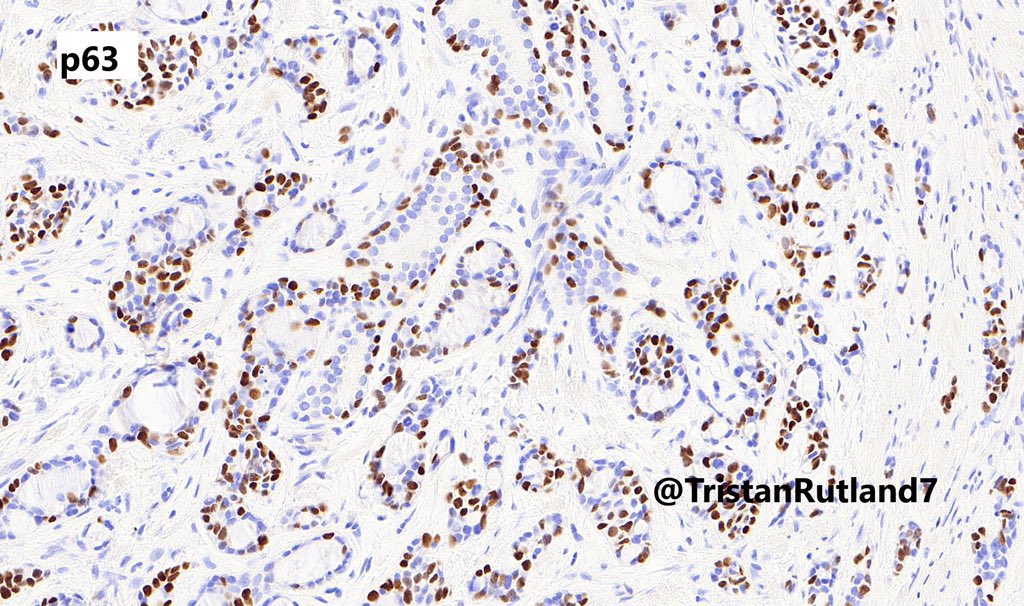✏️Prostate, adult

❓What is the diagnosis?

➡️Answer the upcoming questions in the 🧵or jump straight to the diagnosis below!
👇👇👇
kikoxp.com/posts/13336

#gupath #pathtwitter #pathresidents