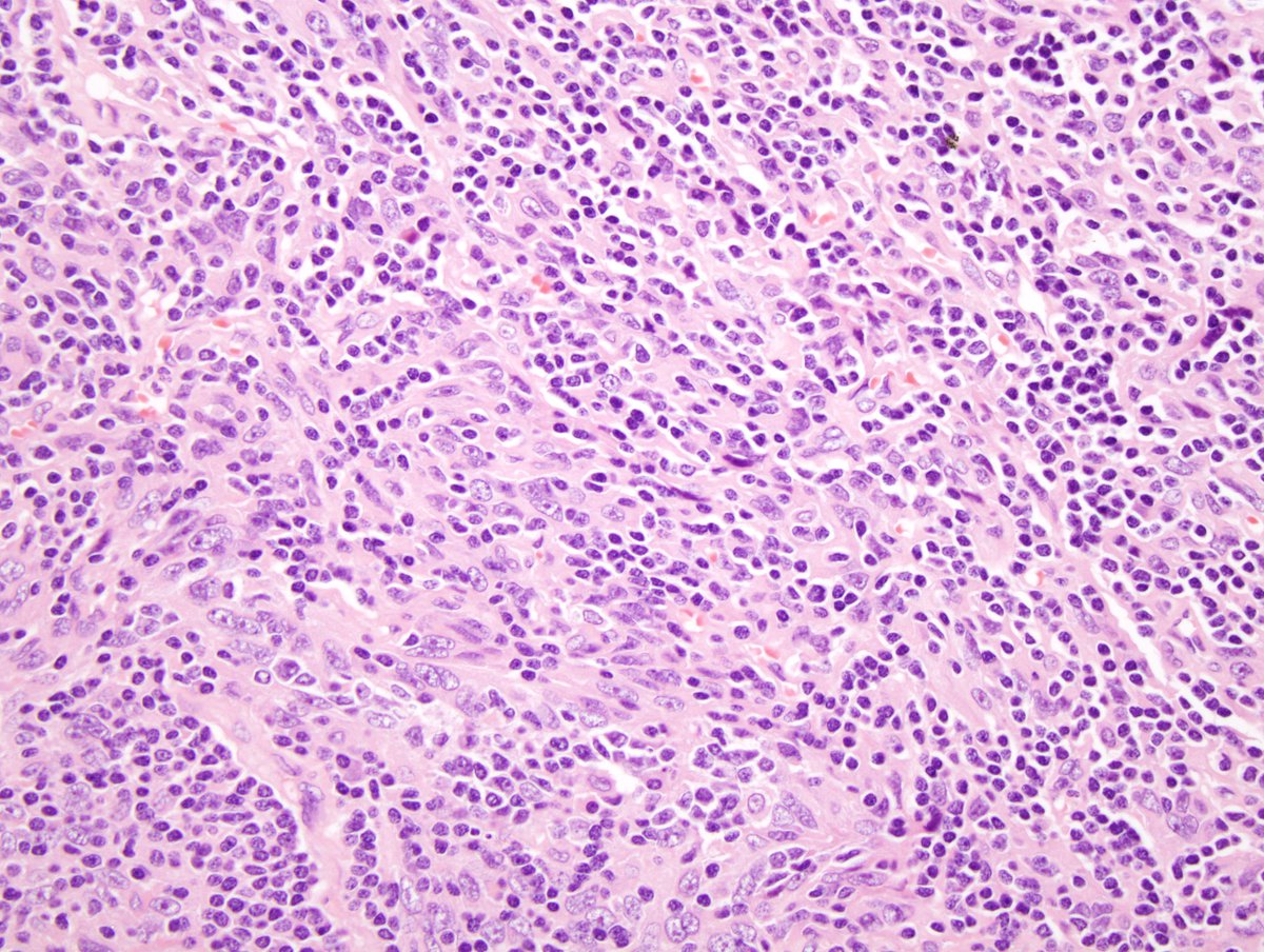 hemepathguy's tweet image. #hemepath follicular dendritic cell sarcoma in LN. CD21 stain