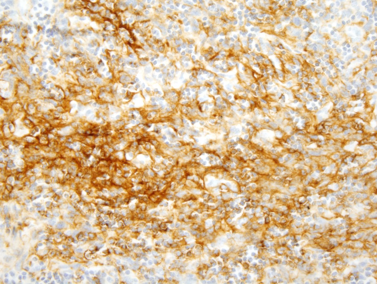 hemepathguy's tweet image. #hemepath follicular dendritic cell sarcoma in LN. CD21 stain