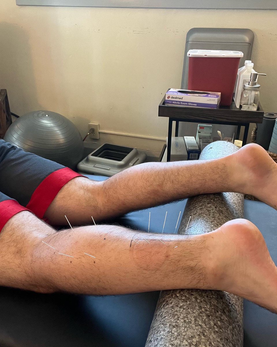 mayonemke's tweet photo. We love a Saturday therapy session. 

Cup therapy ✅
Dry needling ✅
Neuromuscular re-education ✅

#cuptherapy #dryneedling #dryneedlingtherapy #cupping #cuppingtherapy #sportsmedicine #sportsmed #mayonemke https://t.co/BSIwAch0z3