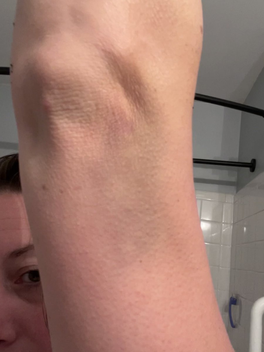 AimeeL221's tweet photo. PSA: Do not partially fall out of a tree 35’ up when a huge branch snaps back &amp; hits you…and save yourself w one arm because you were saving the chainsaw w the other. #priorities #bruisesfordays #lostcount https://t.co/KGxMk701nW